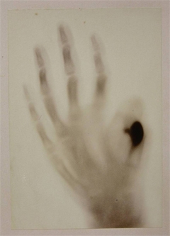 Radiografia mostrando deformações nos dedos de uma mão, H. Teixeira de Bastos, Fev. 1896, fotografia de A. S. e Sousa
